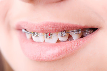 Mouth with brackets braces in medical concept