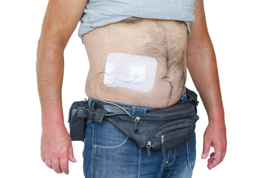 Assist Devices, Kunstherz, LVAD, DCM