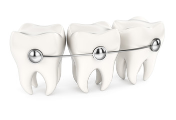 Teeth with braces