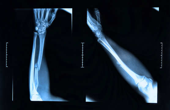 Arm fracture seen on x-ray