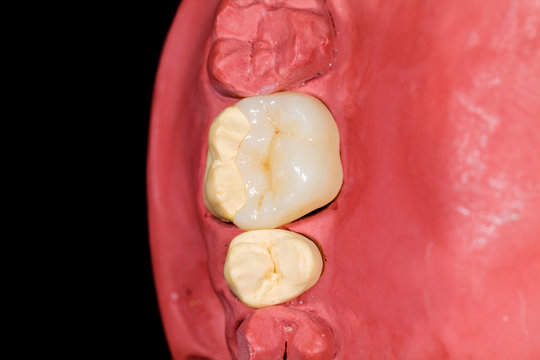 Ceramic molar onlay