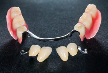 Removable dental prosthesis