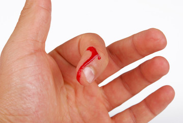 bleeding fingers in work accident