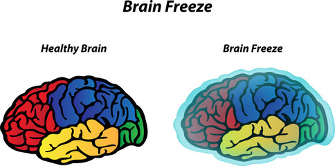 Brain Freeze