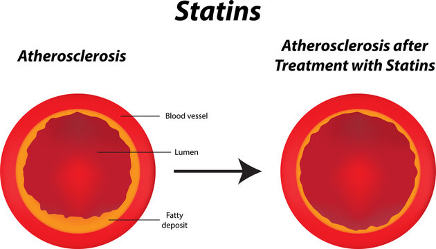 Statins