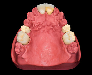 Dental ceramic crowns