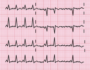 heart beats cardiogram