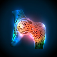 Human hip joint and Osteoporosis - obrazy, fototapety, plakaty
