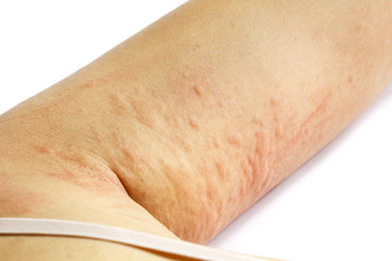 allergic rash skin of patient arm