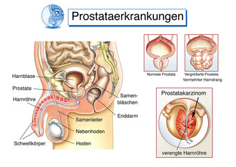 Prostata-Erkrankungen.Vorsteherdrüse - obrazy, fototapety, plakaty