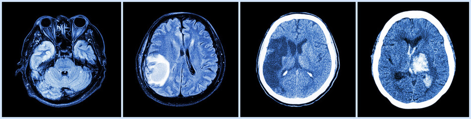 Collection CT scan of brain and multiple disease