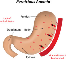 Pernicious Anemia