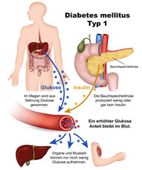 diabetes mellitus typ 1, illustration mit beschreibung, deutsch