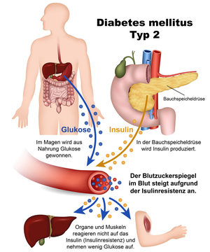 Diabetes Mellitus Typ 2, Illustration Mit Beschreibung Deutsch