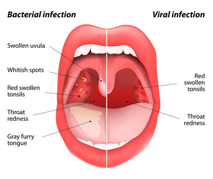The differences between viral and bacterial infections