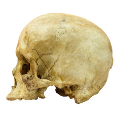 Human Skull Fracture (side) (,Asian)