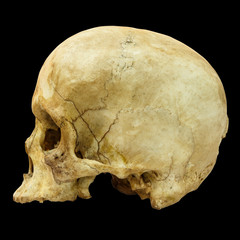 Human Skull Fracture (side) (,Asian)