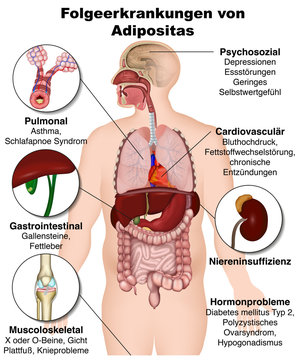 Folgeerkrankungen von Adipositas, &Uuml;bergewicht