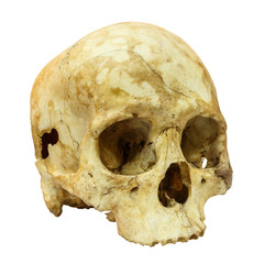 Human Skull Fracture(side) (,Asian) on isolated backgro