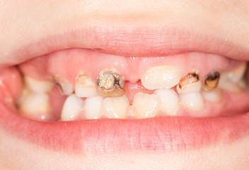 Naklejka premium bad teeth in the mouth. close-up