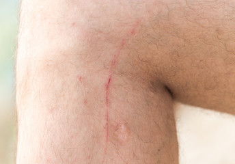 Naklejka premium scars on his leg