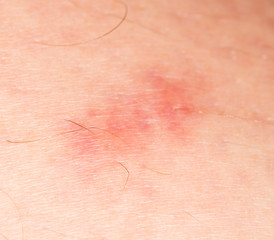 mosquito bites on the skin. close-up