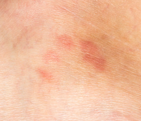 mosquito bites on the skin. close-up