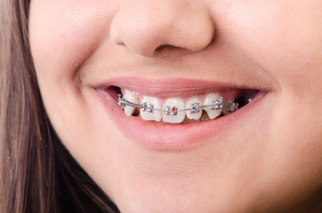 Naklejka premium Mouth with brackets braces in medical concept