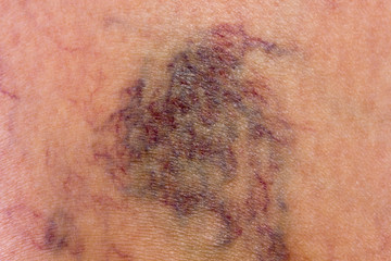 Skin full of varicose veins