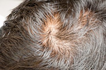 Human alopecia or hair loss problem and grizzly - obrazy, fototapety, plakaty