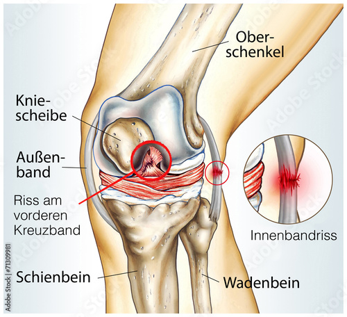 Bänderzerrung Knie Bänderzerrung Knie