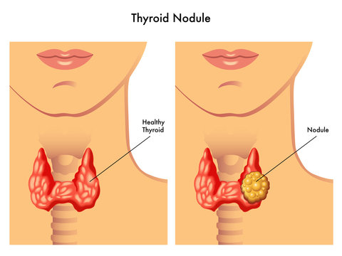 nodulo tiroideo