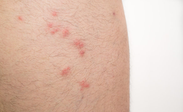 flea bites on caucasian man leg