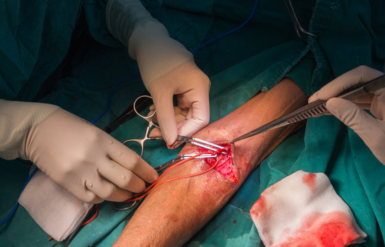 Arteriovenous Fistula Operation