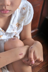 asian little girl with lot of scrapes on body
