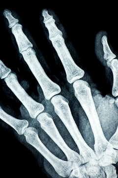 Lastra della mano sinistra