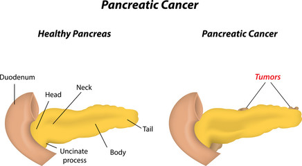Pancreatic Cancer