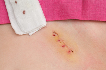 Closeup of fresh appendix surgery scar, appendectomy