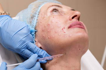 Cosmetic treatment with injection in a clinic