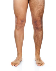 Male hair removal on legs - 71881155