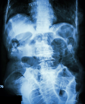 Small bowel obstruction.  X-ray abdomen: small bowel dilated