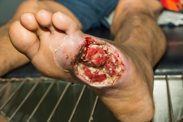 wound of diabetic foot