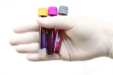 Hand holding vacuum venipuncture test tube