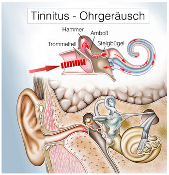 Tinnitus.Ohrensausen.H&ouml;rsturz