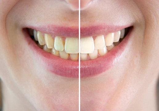 Denti prima e dopo sbiancamento
