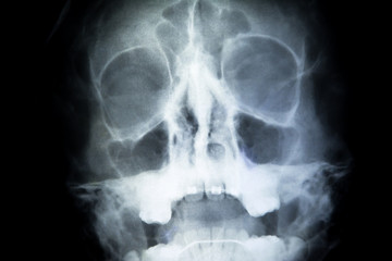 human skull head x-ray