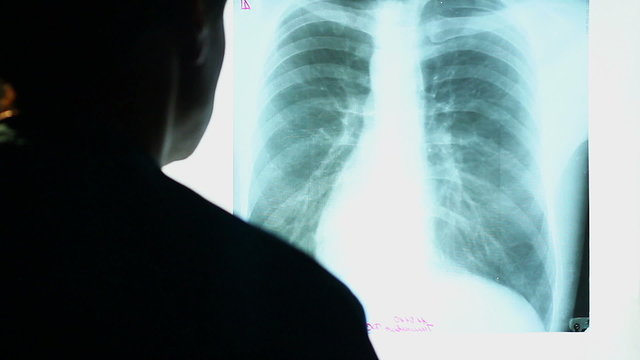Doctor looking at X-ray image of human chest, scanning lungs