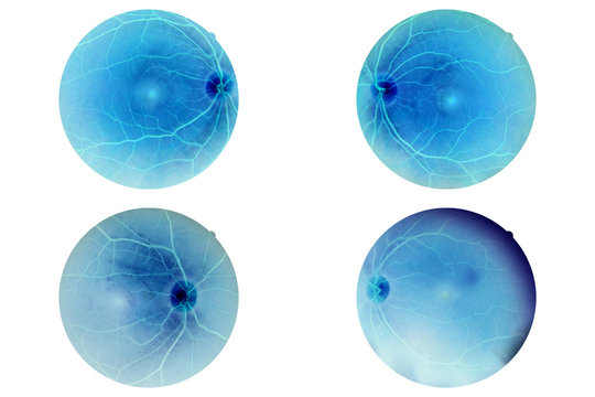 Human Eye Anatomy, Retina, Optic Disc Artery And Vein Etc.