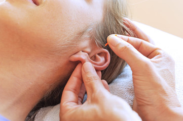 Frau bekommt eine Akupunktur-Behandlung am Ohr