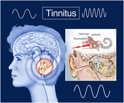 Tinnitus.Ohrgeräusche.Hörsturz